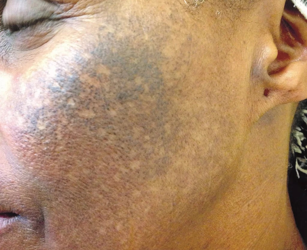 Hydroquinone Danger Moonspells Beauty