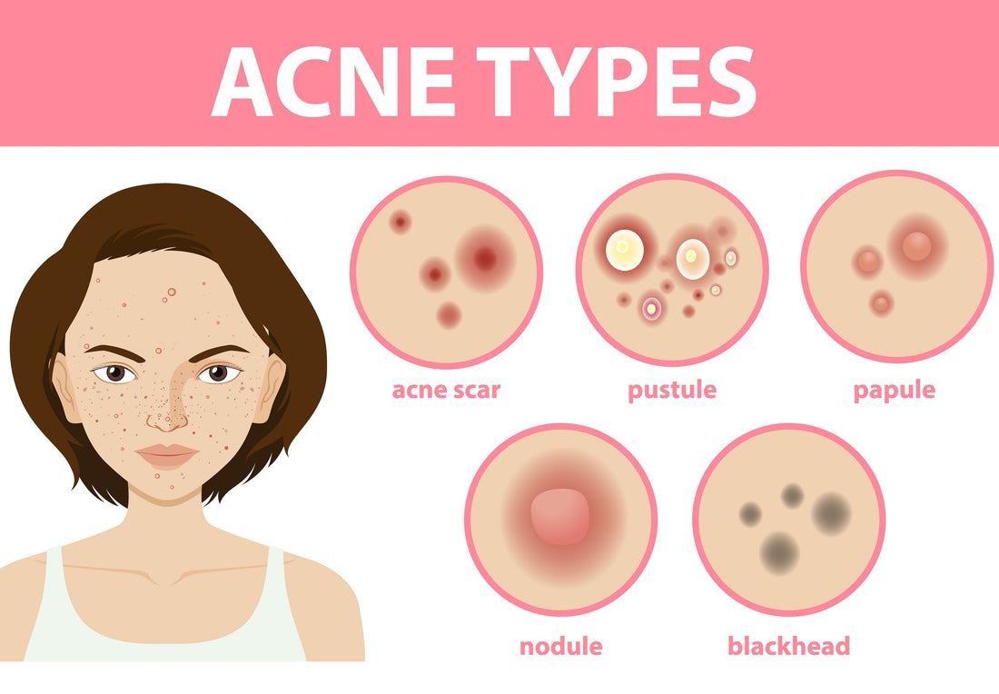 Role of Different Cutibacterium Acnes Strains in Promoting Skin Health Moonspells Beauty