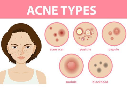 Role of Different Cutibacterium Acnes Strains in Promoting Skin Health Moonspells Beauty