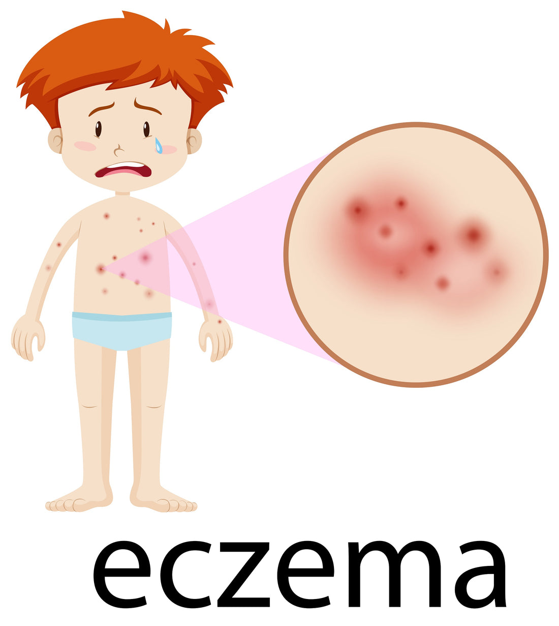 eczema