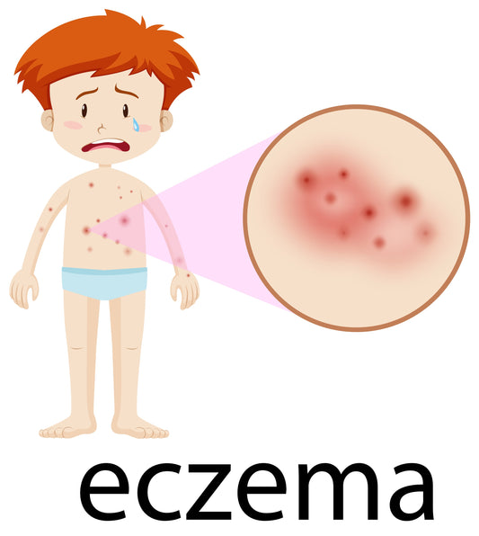eczema
