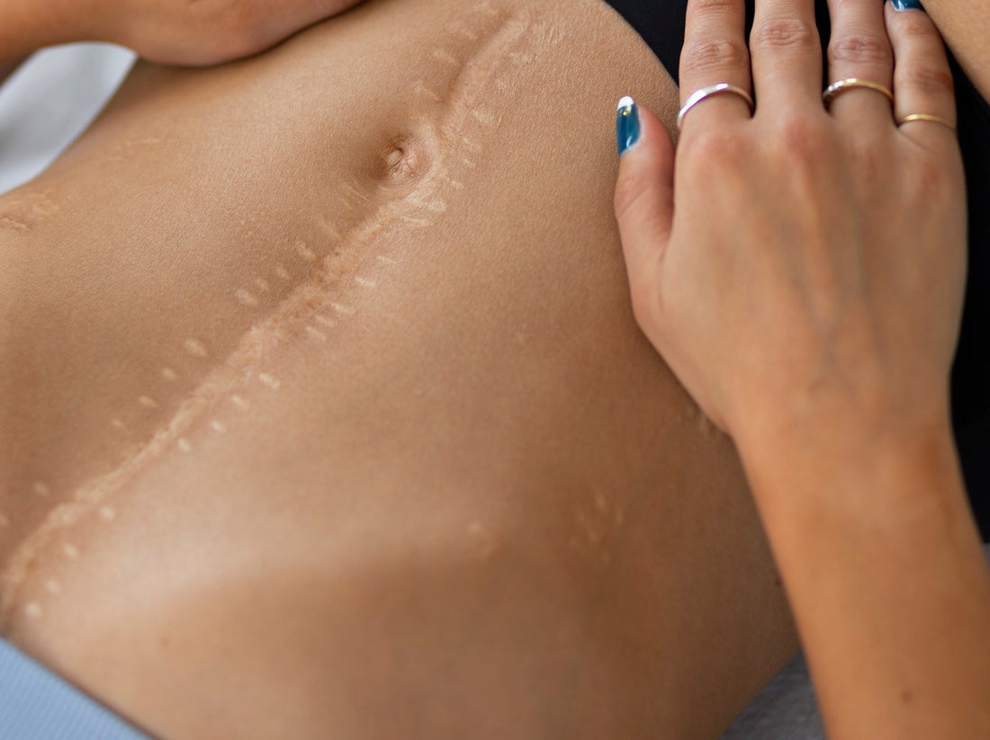 Special Article: Effectiveness of Corticosteroid Tapes and Plasters for Keloids and Hypertrophic Scars