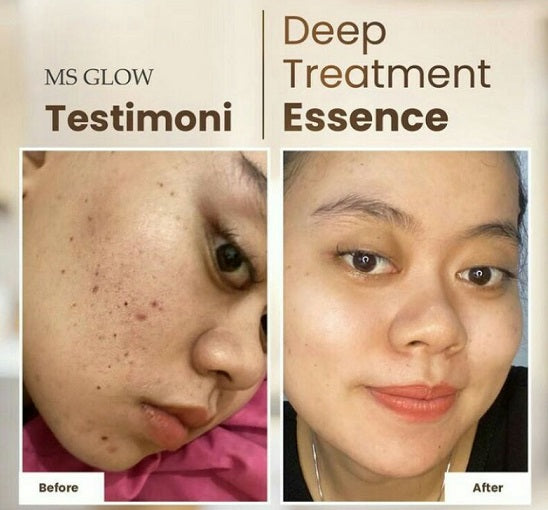 Ms Glow Deep Treatment Essence with Salmon DNA Moonspells Beauty