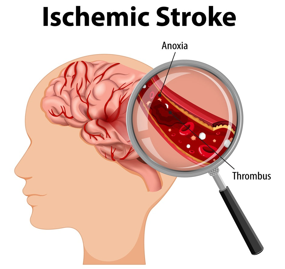Neural Stem Cell Extracellular Vesicles in Ischemic Stroke Therapy