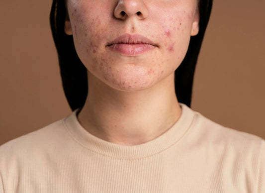 A Promising Approach for Managing Cystic Acne