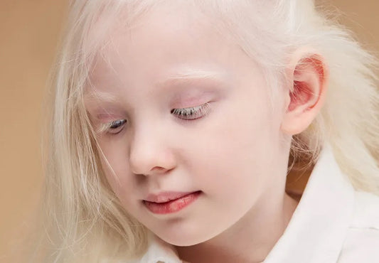 Albinism, Challenging Social Stigma and Promoting Empathy Moonspells Beauty