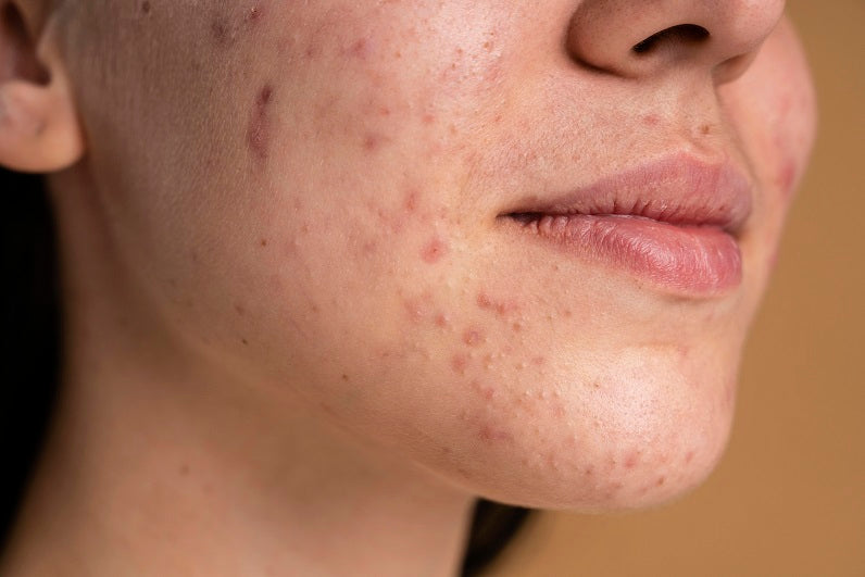 Managing Acne Through Treatment