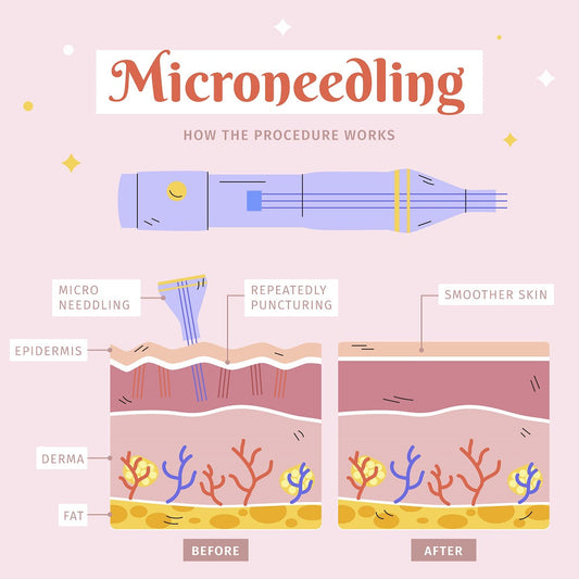 Microneedling, Skin Rejuvenation Treatment