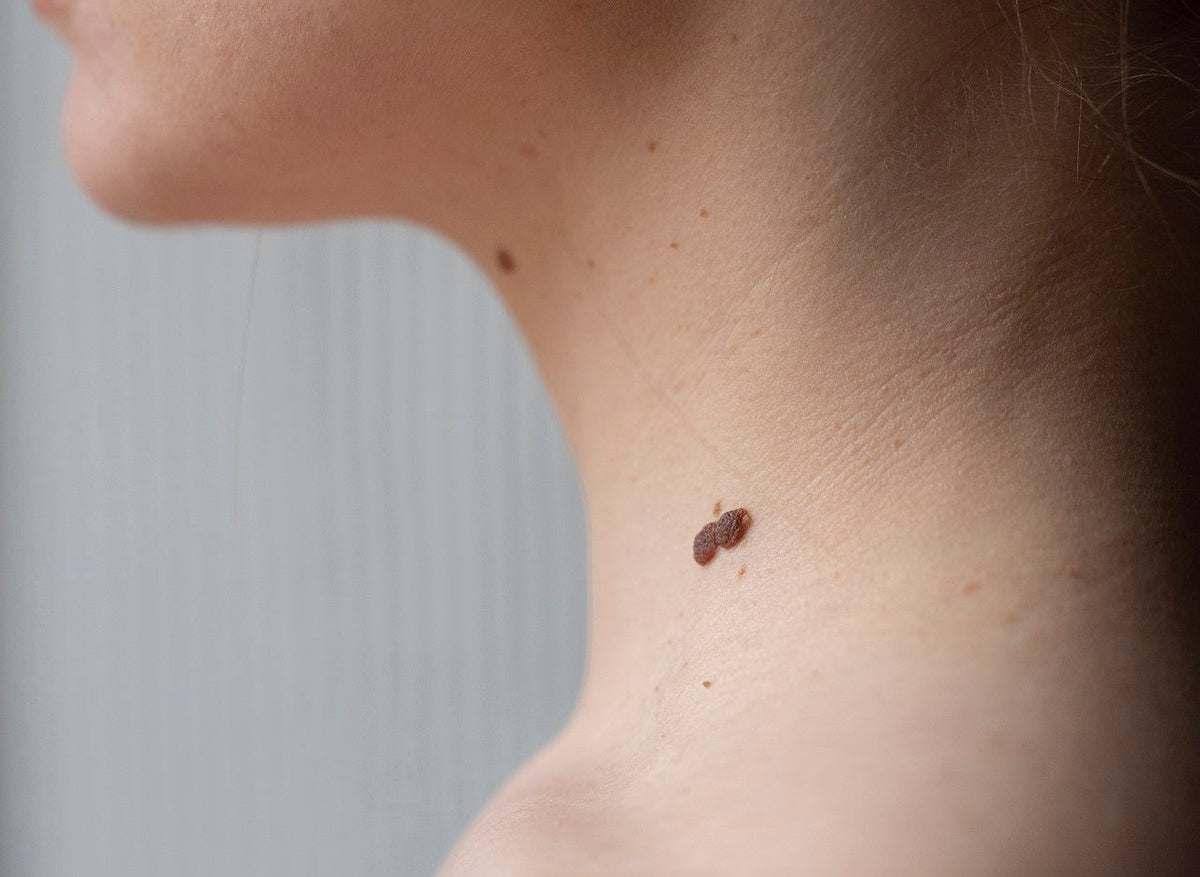 Understanding Skin Lumps and Bumps Moonspells Beauty