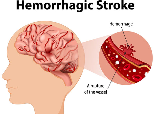 Understanding the Connection Between Brain Bleeds and Amyloid Deposits in Older Adults Moonspells Beauty