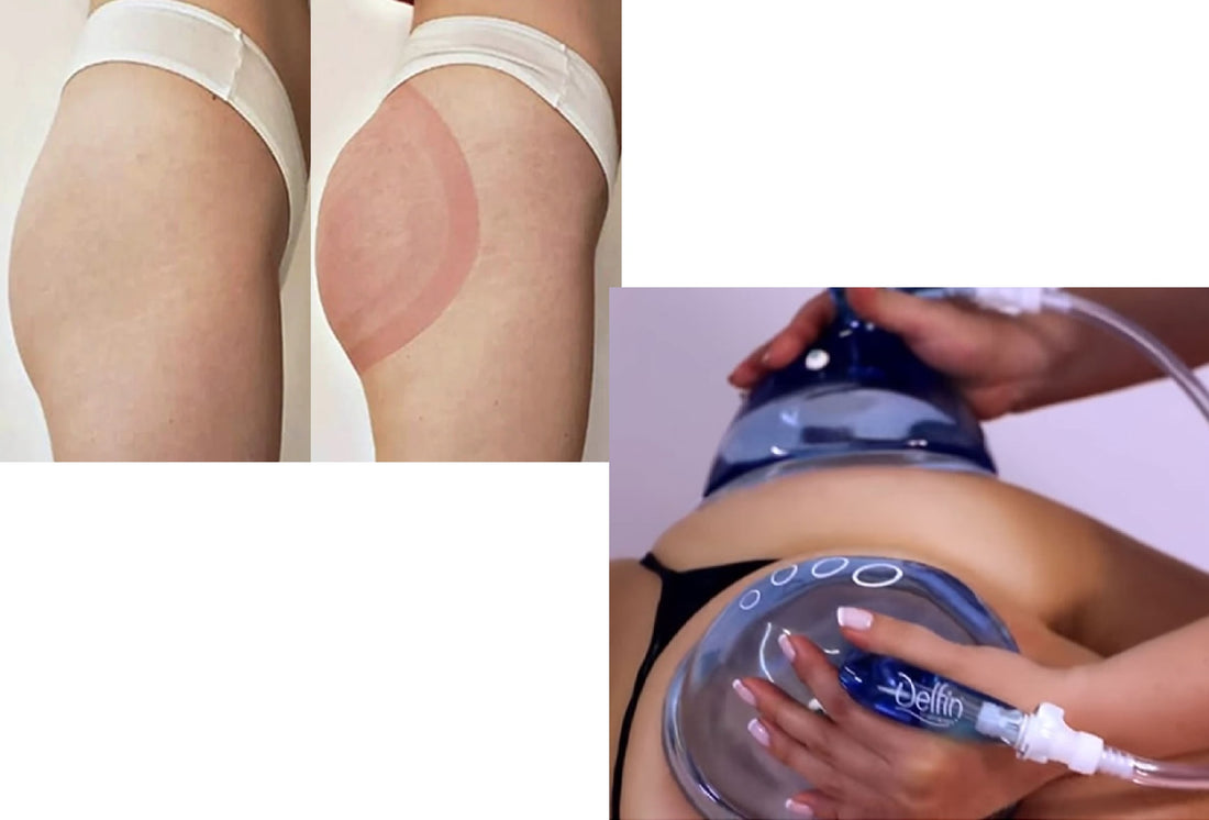 Butt Vacuum Therapy (Butt Cupping)