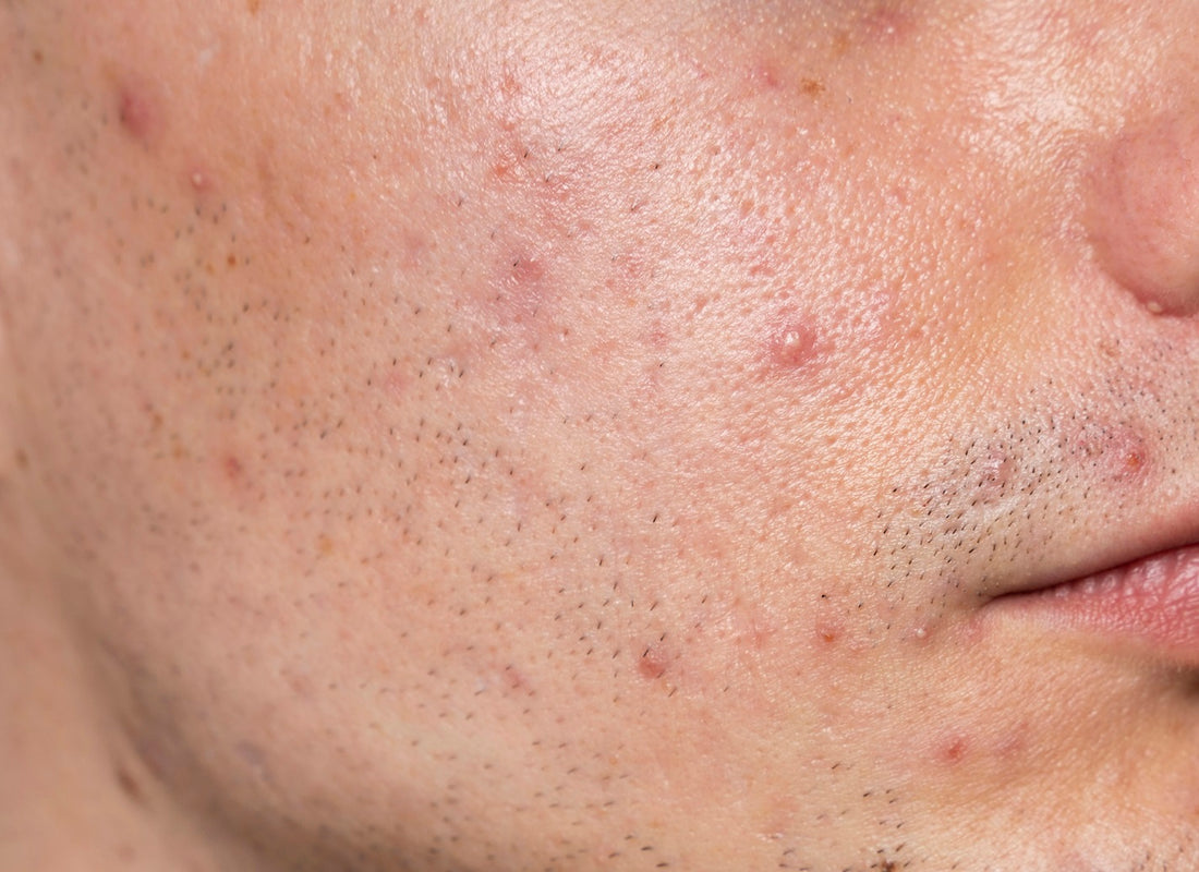 The Impact of Acne on Self-Confidence