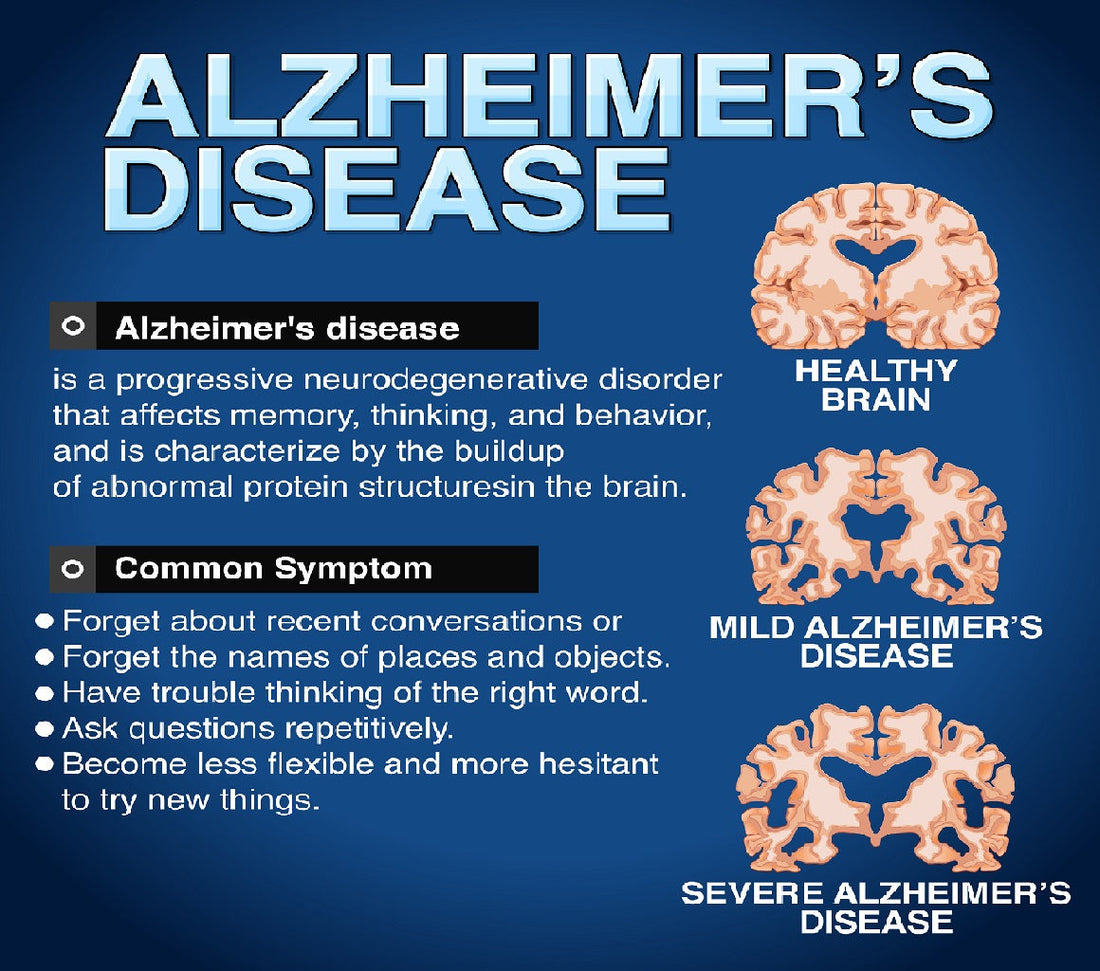 How Alzheimer’s Progresses