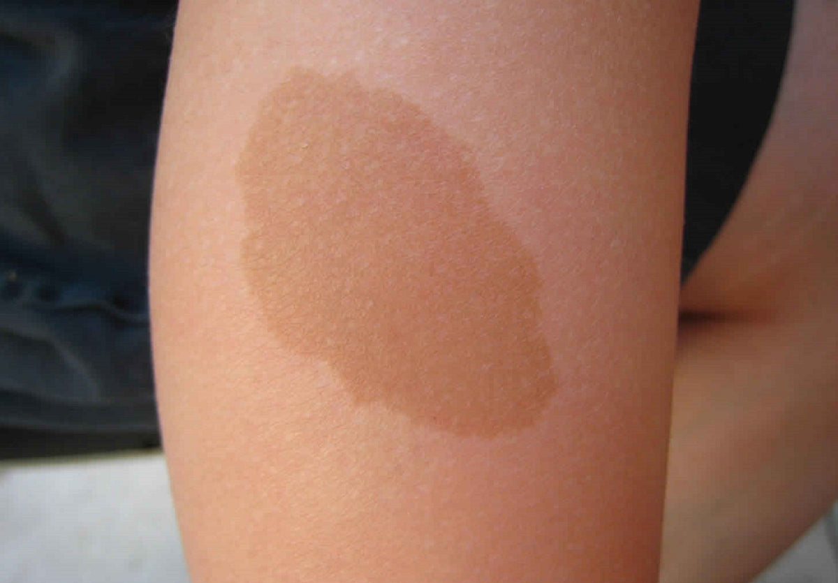 Café Au Lait Spots and Treatment Options