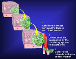 Understanding Cancer Spread and Its Implications