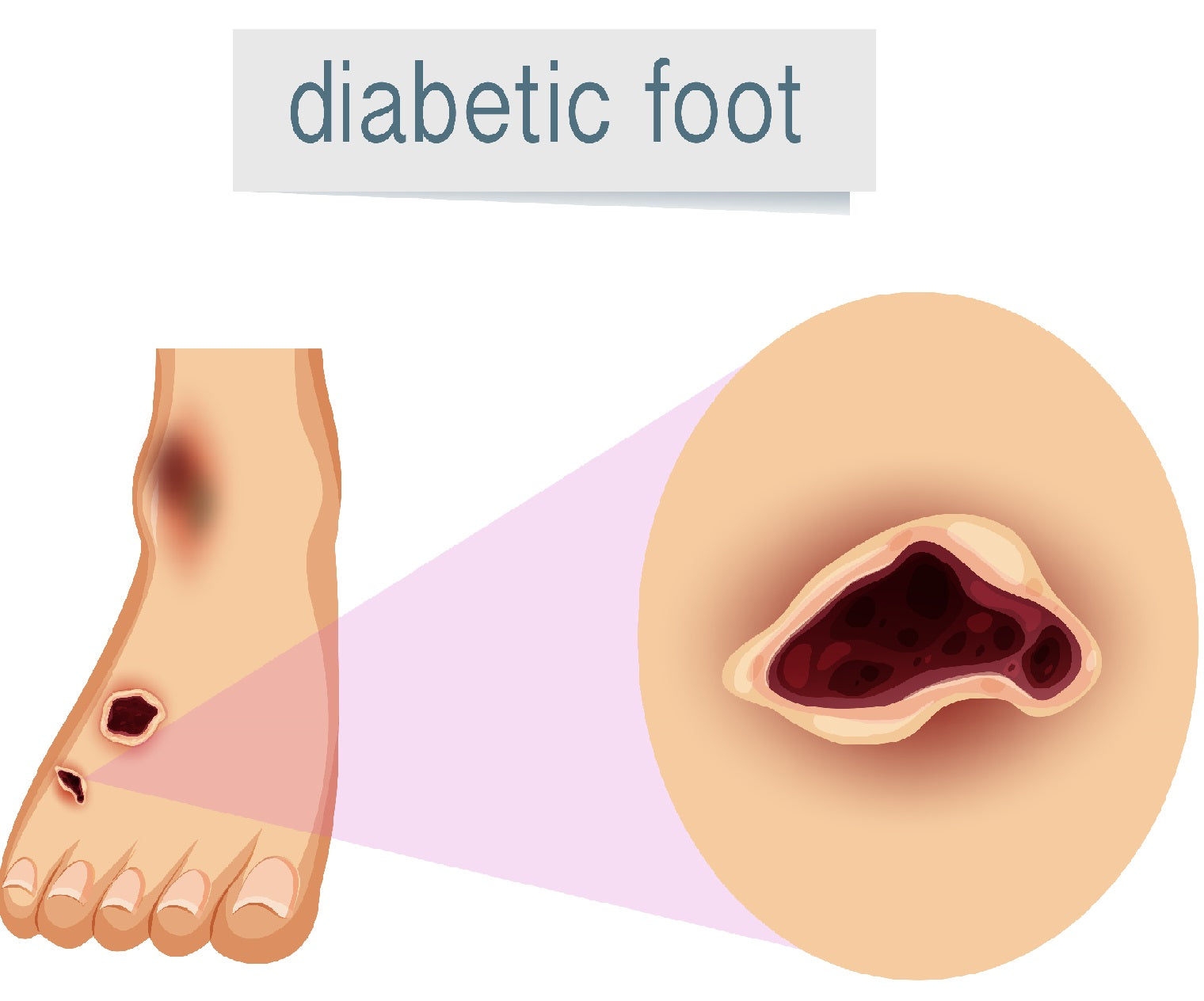 Diabetic Foot Infections And The Role of E. Coli