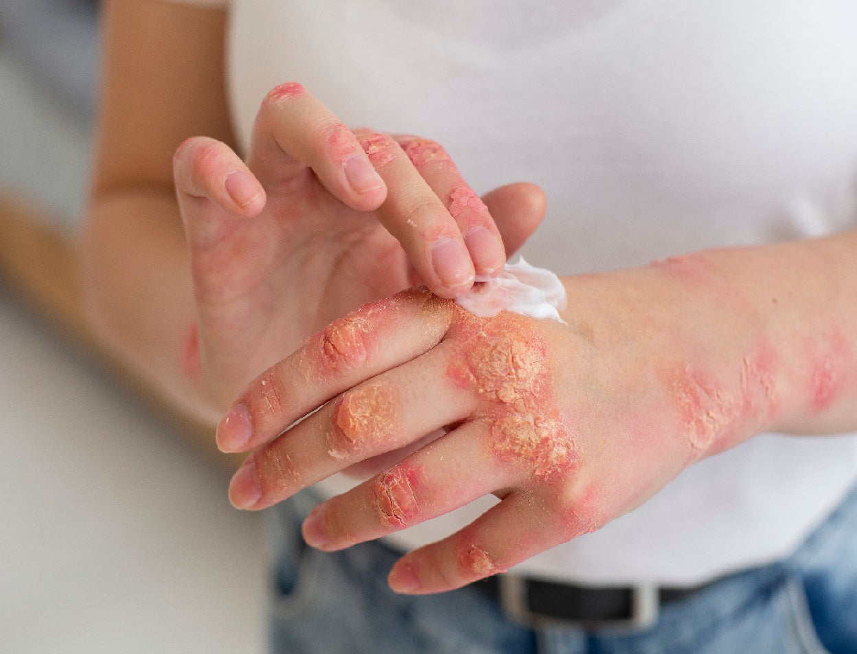 A Revolutionary Discovery in Antifungal Therapies