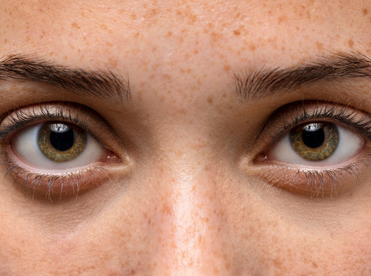 Understanding Hyperpigmentation