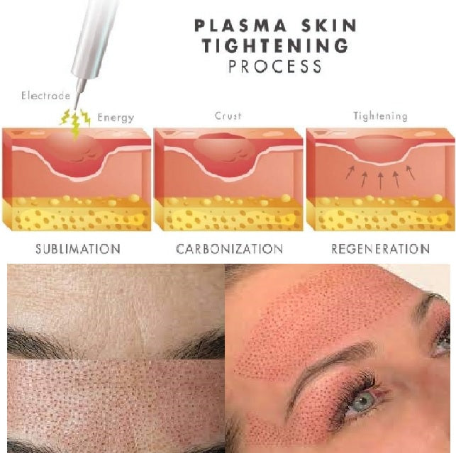 Achieving Youthful Skin with Plasma Fibroblast Therapy