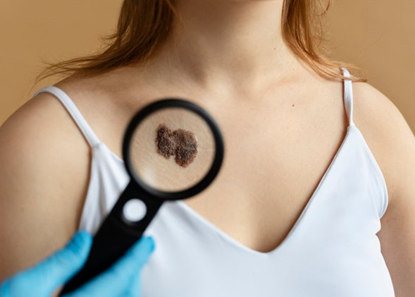 Laser-Based Skin Cancer Prevention