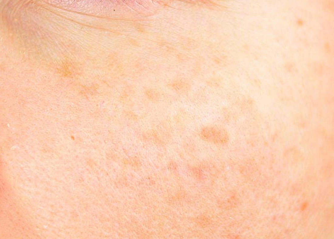 Understanding Lentigo (Liver Spots)