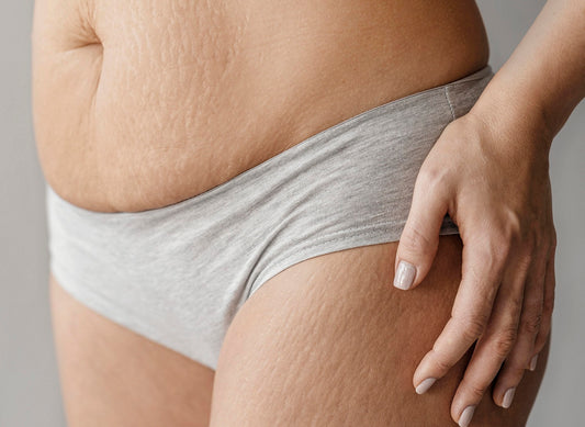 Stretch Marks: Causes and Treatment Options