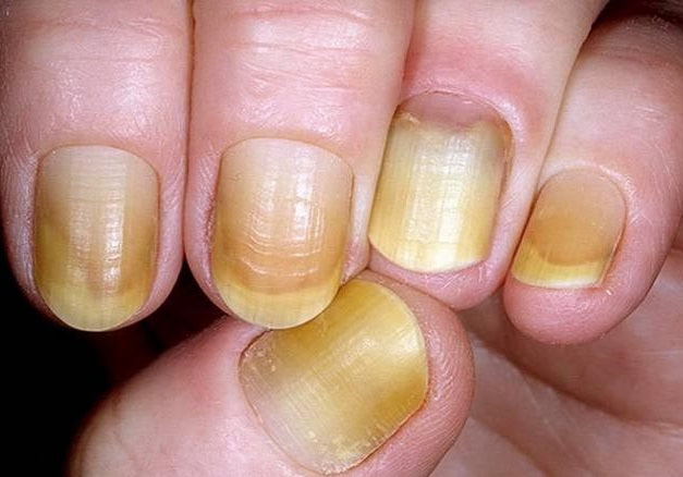 Yellow Nails Syndrome