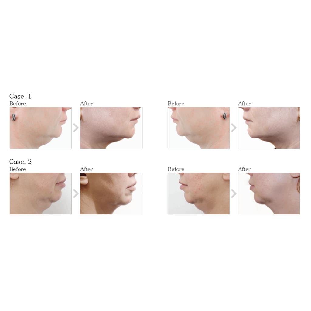 Dermaheal LL Fat and Cellulite Solution - Moonspells Beauty