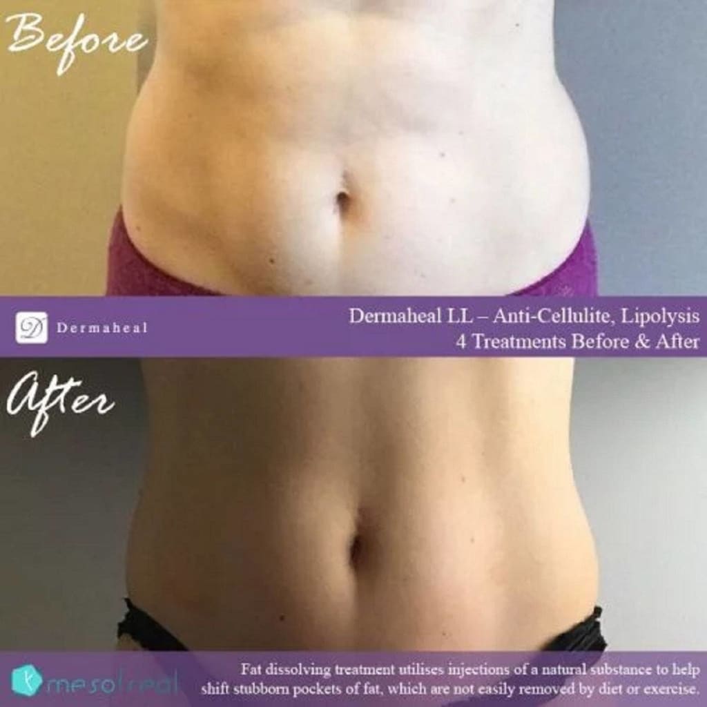 Dermaheal LL Fat and Cellulite Solution - Moonspells Beauty